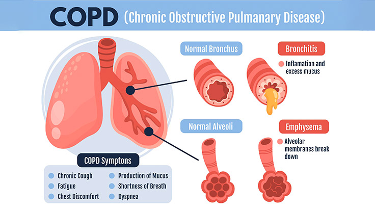 Chronic Obstructive Pulmonary Disease (COPD): Causes, Symptoms, and Treatment